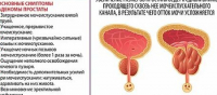 Какой Секс При Простатите